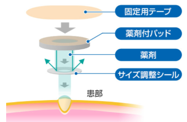 Thuốc trị mụn cóc tại Nhật Bản 9 Thuốc trị mụn cóc tại Nhật Bản 9