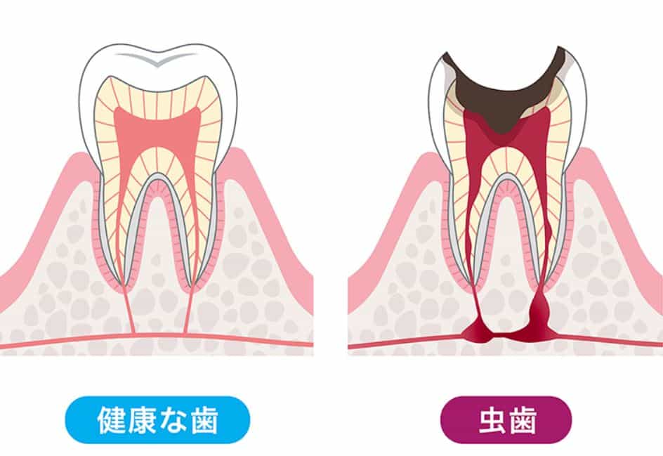 Nhổ răng sâu ở Nhật mất bao nhiêu tiền 1