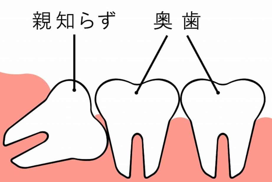 Giới thiệu quy trình nhổ răng khôn ở Nhật 2